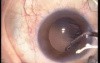Phacoemulsification - IOL