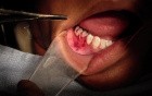 Part 6/8: Root Coverage Surgery - Mandibular Premolar - Suture Finalization
