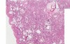 Diffuse Interstitial Fibrosis