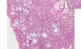 Diffuse Interstitial Fibrosis
