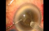Results of phacoemulsification after microtrack filtration operation-a one minute glaucoma procedure
