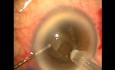 Results of phacoemulsification after microtrack filtration operation-a one minute glaucoma procedure