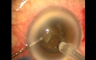 Results of phacoemulsification after microtrack filtration operation-a one minute glaucoma procedure