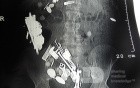 Multiple Foreign bodies in the GI tract (4 of 12)