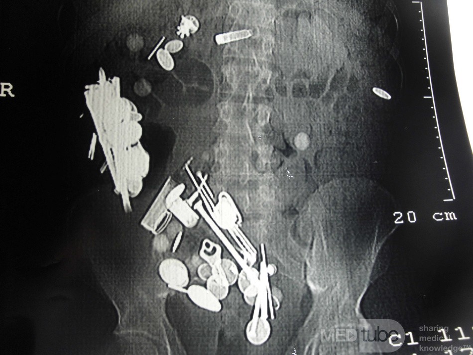 Multiple Foreign bodies in the GI tract (4 of 12)