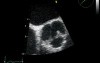 Severe Aortic Valve Regurgitation In Rheumatic Disease