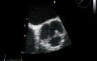 Severe Aortic Valve Regurgitation In Rheumatic Disease
