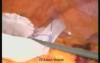 Large Paraumblical Hernia