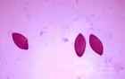 Colonoscopy observing a trichuris in the cecum (4 of 8)