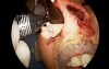 Empty Nose Syndrome - Allograft Implantation