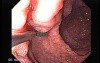 Gastric Cancer - Endoscopy (6 of 15)