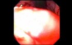 Retrograde Gastroplicature - Suturing - 3/3