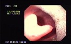 Bilobulated Uvula