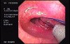 Flexible Endoscopic Suturing - Sew-Right Device