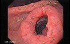 Gastric Cancer - Intestinal Metaplasia - Endoscopy (4 of 7)
