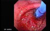 Esophageal Achalasia - Pneumatic Balloon Dilation, Video nr 1