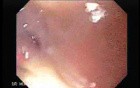 Post-irradiation Stenosis of the Esophagus - 77 Years-Old Female