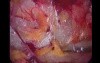 Total Extra Peritoneal (TEP) in 10 steps - Part 3