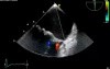 Prolapse Mitral Valve