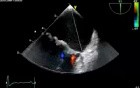 Prolapse Mitral Valve