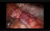Distal Pancreatectomy Spleen Preserving