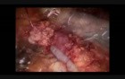 Distal Pancreatectomy Spleen Preserving