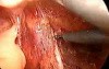 Laparoscopic abdominoperineal resection