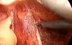 Laparoscopic abdominoperineal resection