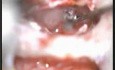 Myringoplasty Part 2