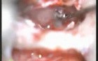 Myringoplasty Part 2