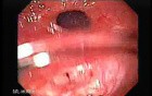 Ileal Neobladder Substitution (ileal bladder) (4 of 9)