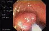 Tubulo - Villous Adenoma - Endoscopy (6 of 28)