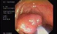 Tubulo - Villous Adenoma - Endoscopy (6 of 28)