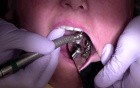 Finishing Crown Margin After Cementation