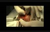 Chiloplasty by Modification Doctor G. Kocharyan