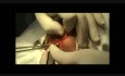 Chiloplasty by Modification Doctor G. Kocharyan