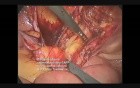 Laparoscopic TAPP Hernia Repair For Left Femoral Hernia
