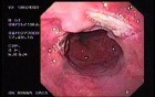Banding of Esophageal Varices - Exudative Ulcer