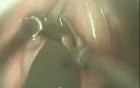 Vocal Nodule Excision With Microlaryngeal Surgery (MLS)