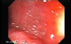 Crohn´s Colitis (2 of 3)