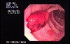 Stalked Polyp