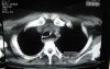 Esophagus - Pneumatic Dilation for Achalasia (25 of 31)