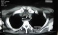 Esophagus - Pneumatic Dilation for Achalasia (25 of 31)