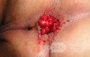 Endoscopic Resection of Giant Tubulo-Villous of
 the rectum (1 of 35)