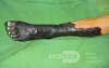 Dry gangrene left lower limb in diabetic patient