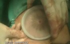 Laparoscopic Right Hemicolectomy