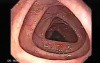 Colonoscopy video