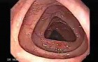 Colonoscopy video