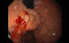 Gastric Varices - Endoscopic Ablation With Cyanoacrylate Glue (6 of 18)