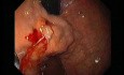 Gastric Varices - Endoscopic Ablation With Cyanoacrylate Glue (6 of 18)